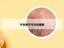 牛皮癣不可以吃醋嘛
