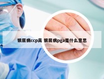 银屑病ccp高 银屑病pga是什么意思