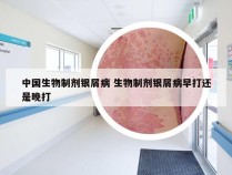 中国生物制剂银屑病 生物制剂银屑病早打还是晚打