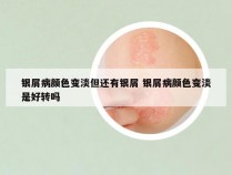 银屑病颜色变淡但还有银屑 银屑病颜色变淡是好转吗