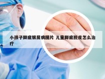 小孩子脚底银屑病图片 儿童脚底脱皮怎么治疗