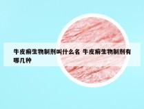牛皮癣生物制剂叫什么名 牛皮癣生物制剂有哪几种