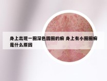 身上出现一圈深色圆圈的癣 身上有小圈圈癣是什么原因