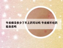 牛皮癣没多少了不上药可以吗 牛皮癣不吃药能自愈吗