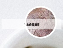 牛皮癣是湿毒