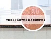 中国什么名人得了银屑病 患银屑病的明星