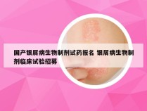 国产银屑病生物制剂试药报名 银屑病生物制剂临床试验招募