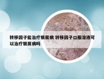 转移因子能治疗银屑病 转移因子口服溶液可以治疗银屑病吗