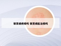 银霄病疼痒吗 银霄病能治根吗