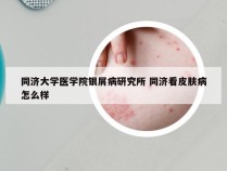 同济大学医学院银屑病研究所 同济看皮肤病怎么样