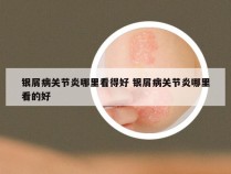 银屑病关节炎哪里看得好 银屑病关节炎哪里看的好