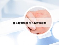 什幺是银屑病 什么叫做银屑病