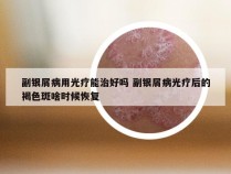 副银屑病用光疗能治好吗 副银屑病光疗后的褐色斑啥时候恢复
