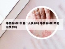 牛皮癣和肝炎有什么关系吗 牛皮癣和肝功能有关系吗