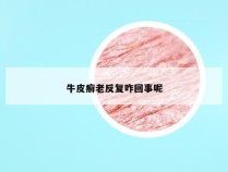 牛皮癣老反复咋回事呢