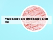 牛皮癣影响事业单位 银屑病影响事业单位体检吗