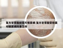 复方甘草酸胶苷片银屑病 复方甘草酸苷胶囊对银屑病效果怎样