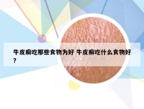 牛皮癣吃那些食物为好 牛皮癣吃什么食物好?