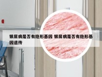 银屑病是否有隐形基因 银屑病是否有隐形基因遗传