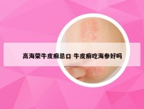 高海荣牛皮癣忌口 牛皮癣吃海参好吗