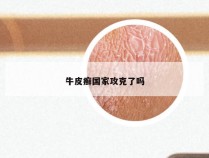 牛皮癣国家攻克了吗