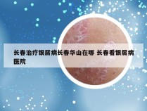 长春治疗银屑病长春华山在哪 长春看银屑病医院