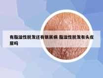 有脂溢性脱发还有银屑病 脂溢性脱发有头皮屑吗