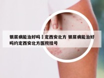 银屑病能治好吗約定西安北方 银屑病能治好吗约定西安北方医院挂号