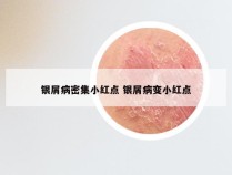 银屑病密集小红点 银屑病变小红点