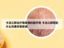 卡泊三醇治疗银屑病的副作用 卡泊三醇搭配什么效果好银屑病