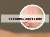 点滴型银屑病hiv 点滴型银屑病图片