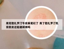 用完他扎罗汀牛皮癣更红了 用了他扎罗汀乳膏脱皮还能继续用吗