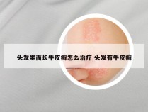 头发里面长牛皮癣怎么治疗 头发有牛皮癣
