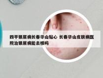 四平银屑病长春华山贴心 长春华山皮肤病医院治银屑病能去根吗