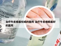 治疗牛皮癣最权威的医院 治疗牛皮病癣最好的医院