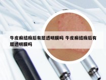 牛皮癣结痂后有层透明膜吗 牛皮癣结痂后有层透明膜吗