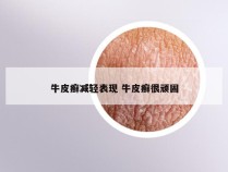 牛皮癣减轻表现 牛皮癣很顽固