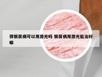 得银屑病可以用激光吗 银屑病用激光能治好嘛