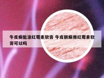 牛皮癣能涂红霉素软膏 牛皮肤癣用红霉素软膏可以吗