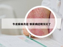牛皮癣来月经 银屑病经期又红了