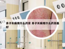 鼻子长癣用什么药膏 鼻子长癣用什么药膏最好