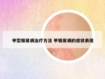 甲型银屑病治疗方法 甲银屑病的症状表现