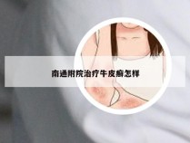 南通附院治疗牛皮癣怎样
