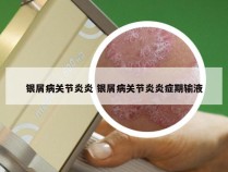 银屑病关节炎炎 银屑病关节炎炎症期输液