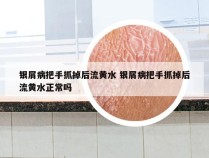 银屑病把手抓掉后流黄水 银屑病把手抓掉后流黄水正常吗
