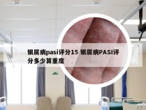 银屑病pasi评分15 银屑病PASI评分多少算重度