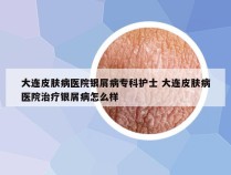 大连皮肤病医院银屑病专科护士 大连皮肤病医院治疗银屑病怎么样
