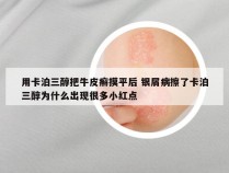 用卡泊三醇把牛皮癣摸平后 银屑病擦了卡泊三醇为什么出现很多小红点