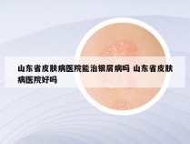 山东省皮肤病医院能治银屑病吗 山东省皮肤病医院好吗