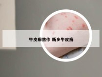 牛皮癣焦作 新乡牛皮癣
